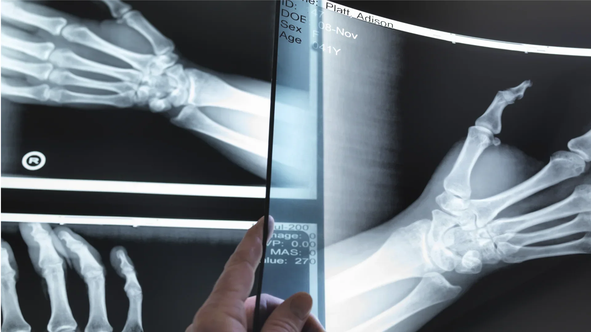 The Quiet Decade for Your Bones